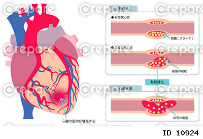 心臓の病気の図解イラスト