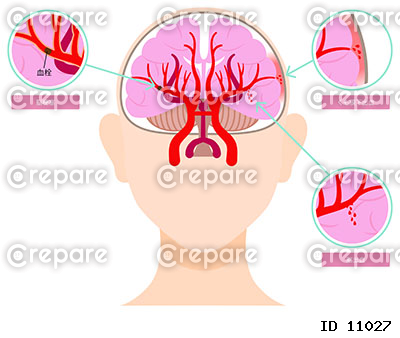 脳梗塞、脳出血の図解